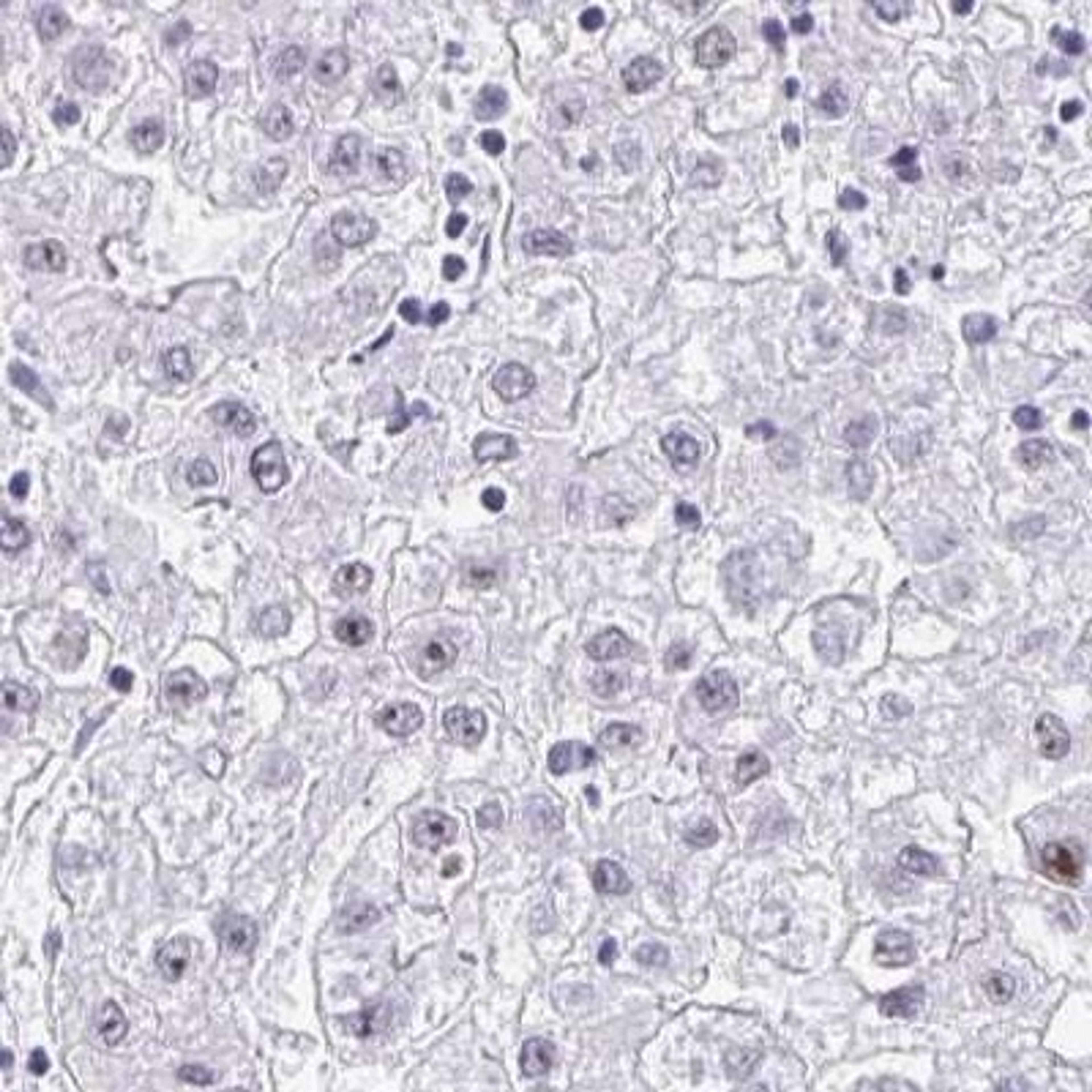 Immunohistochemistry: NOP10 Antibody [NBP2-32441] - liver cancer