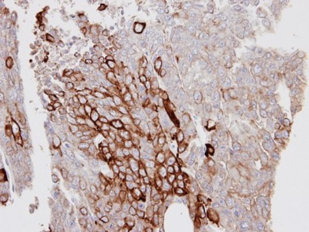 Immunohistochemistry-Paraffin: Cytokeratin 6a Antibody [NBP1-31443] - Paraffin-embedded D54MG xenograft, using antibody at 1:100 dilution.