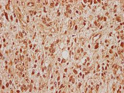 IHC image of CSB-PA022683LA01HU diluted at 1:100 and staining in paraffin-embedded human glioma cancer performed on a Leica BondTM system. After dewaxing and hydration, antigen retrieval was mediated by high pressure in a citrate buffer (pH 6.0). Section was blocked with 10% normal goat serum 30min at RT. Then primary antibody (1% BSA) was incubated at 4°C overnight. The primary is detected by a biotinylated secondary antibody and visualized using an HRP conjugated SP system.