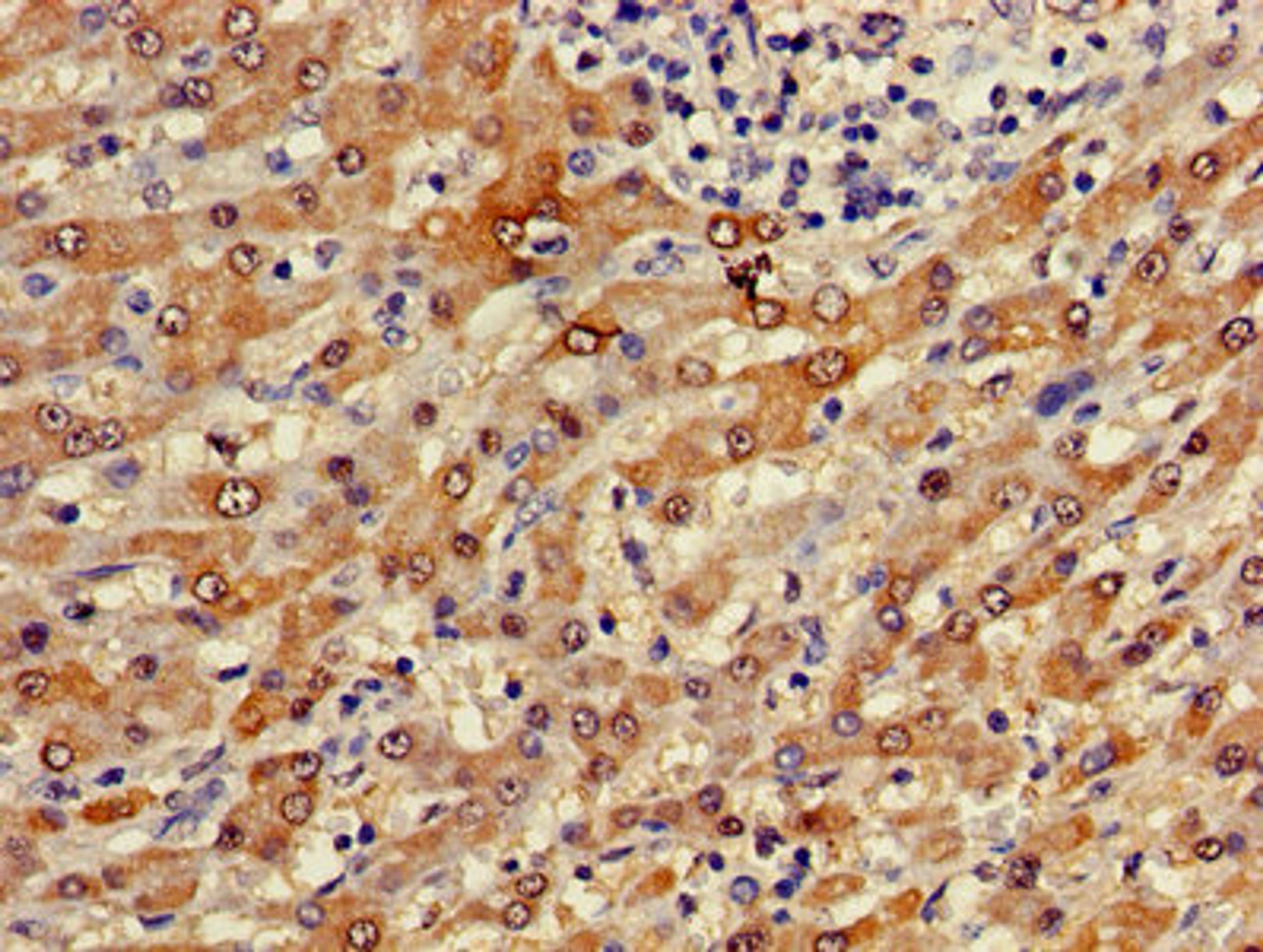 Immunohistochemistry of paraffin-embedded human liver cancer using CSB-PA002922LA01HU at dilution of 1:100
