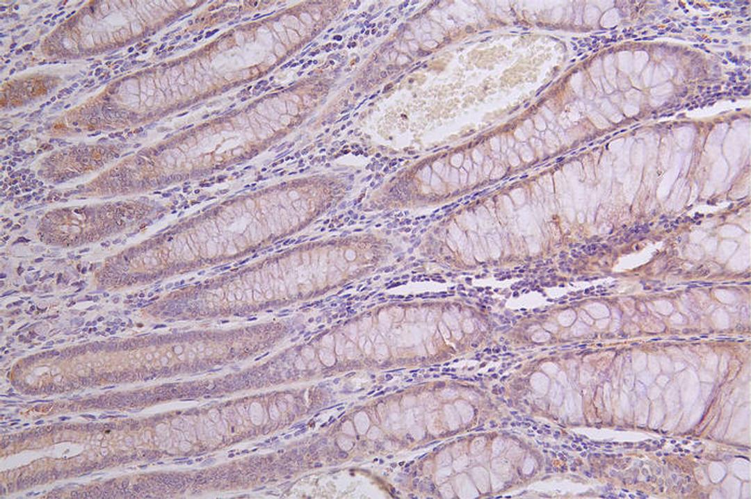 IHC image of CSB-RA950991A0HU diluted at 1:100 and staining in paraffin-embedded human rectal cancer performed on a Leica BondTM system. After dewaxing and hydration, antigen retrieval was mediated by high pressure in a citrate buffer (pH 6.0). Section was blocked with 10% normal goat serum 30min at RT. Then primary antibody (1% BSA) was incubated at 4°C overnight. The primary is detected by a Goat anti-rabbit polymer IgG labeled by HRP and visualized using 0.14% DAB.