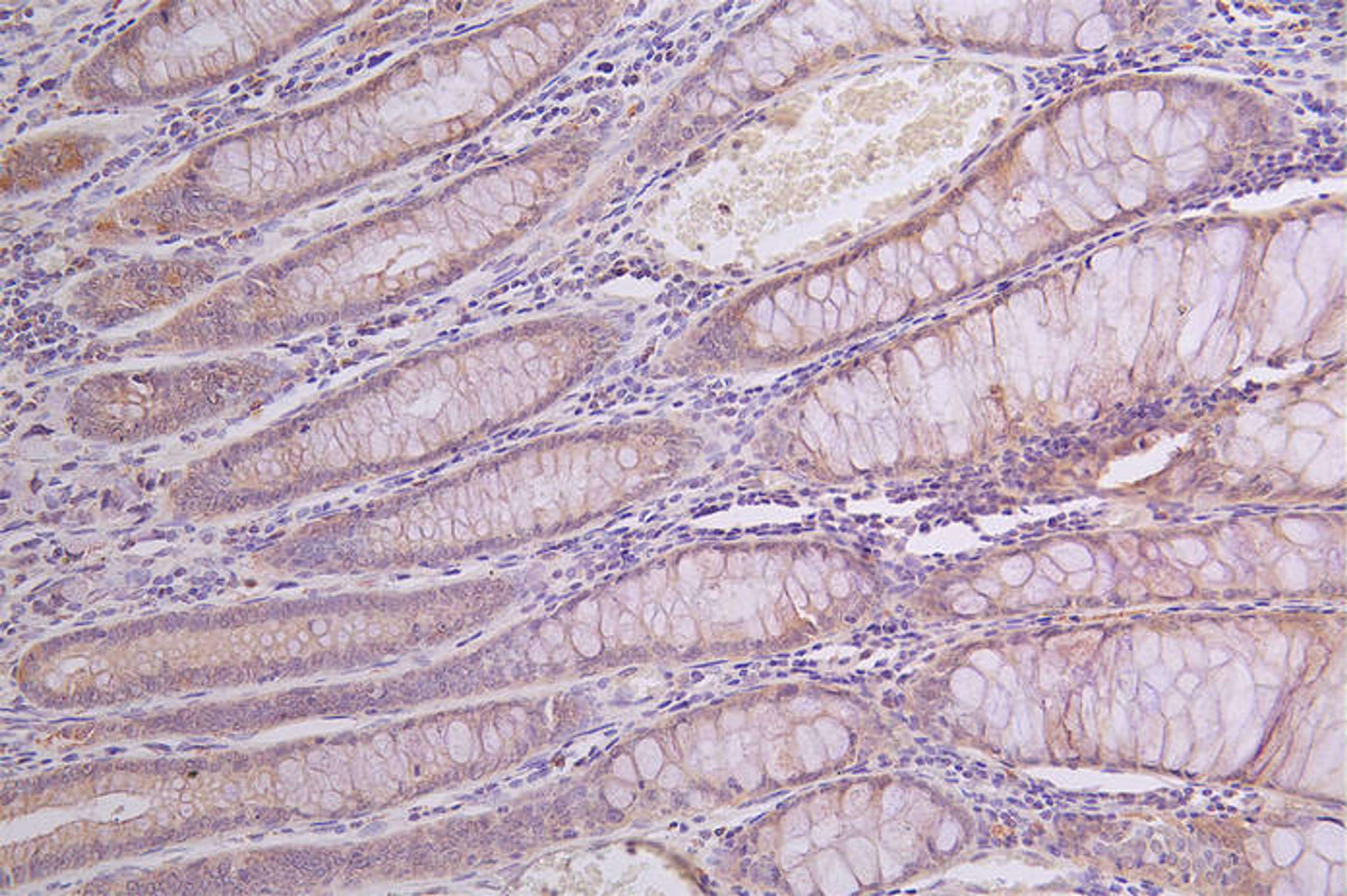 IHC image of CSB-RA950991A0HU diluted at 1:100 and staining in paraffin-embedded human rectal cancer performed on a Leica BondTM system. After dewaxing and hydration, antigen retrieval was mediated by high pressure in a citrate buffer (pH 6.0). Section was blocked with 10% normal goat serum 30min at RT. Then primary antibody (1% BSA) was incubated at 4°C overnight. The primary is detected by a Goat anti-rabbit polymer IgG labeled by HRP and visualized using 0.14% DAB.