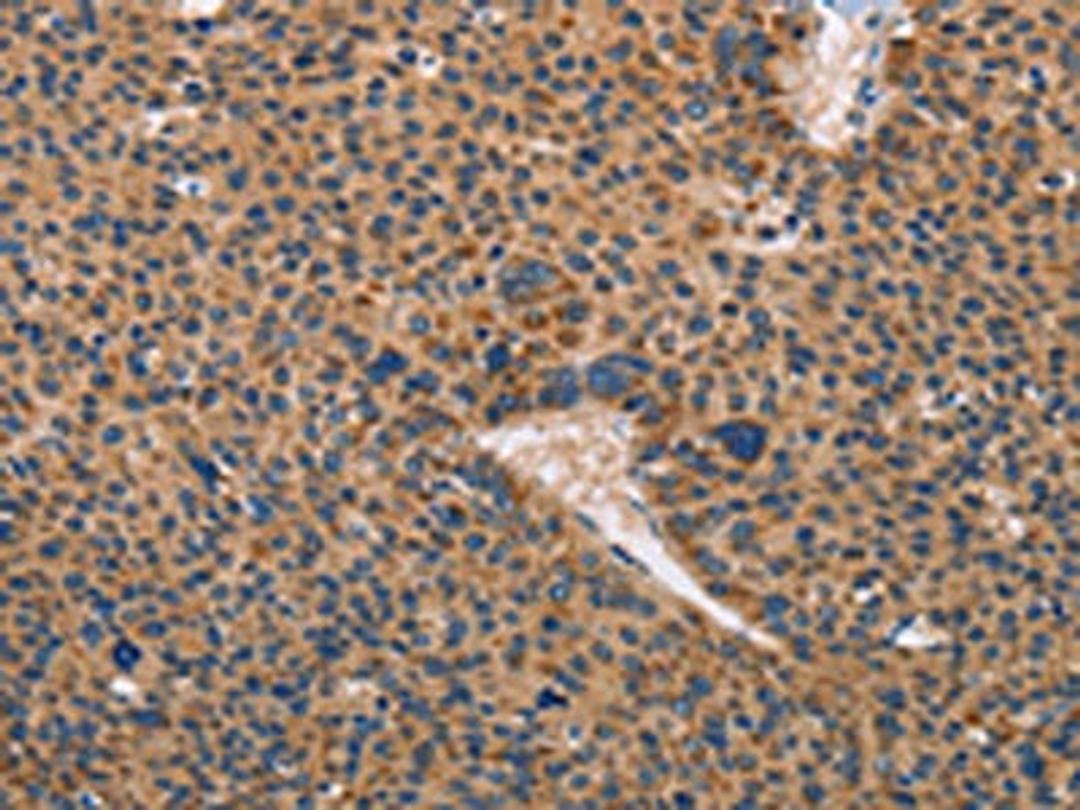 The image on the left is immunohistochemistry of paraffin-embedded Human liver cancer tissue using CSB-PA218546(TLR3 Antibody) at dilution 1/50, on the right is treated with fusion protein. (Original magnification: ×200)