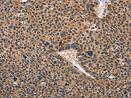 The image on the left is immunohistochemistry of paraffin-embedded Human liver cancer tissue using CSB-PA218546(TLR3 Antibody) at dilution 1/50, on the right is treated with fusion protein. (Original magnification: ×200)