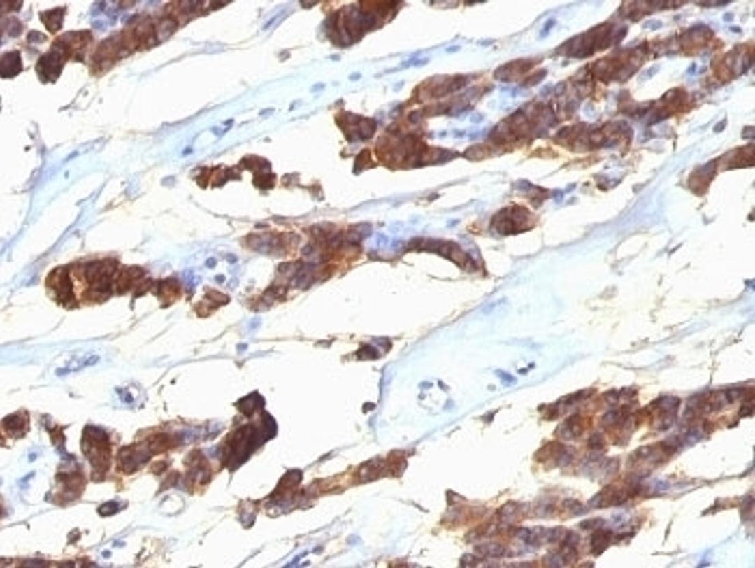 Formalin-fixed, paraffin-embedded human thyroid carcinoma stained with anti-Thyroglobulin antibody (SPM221).