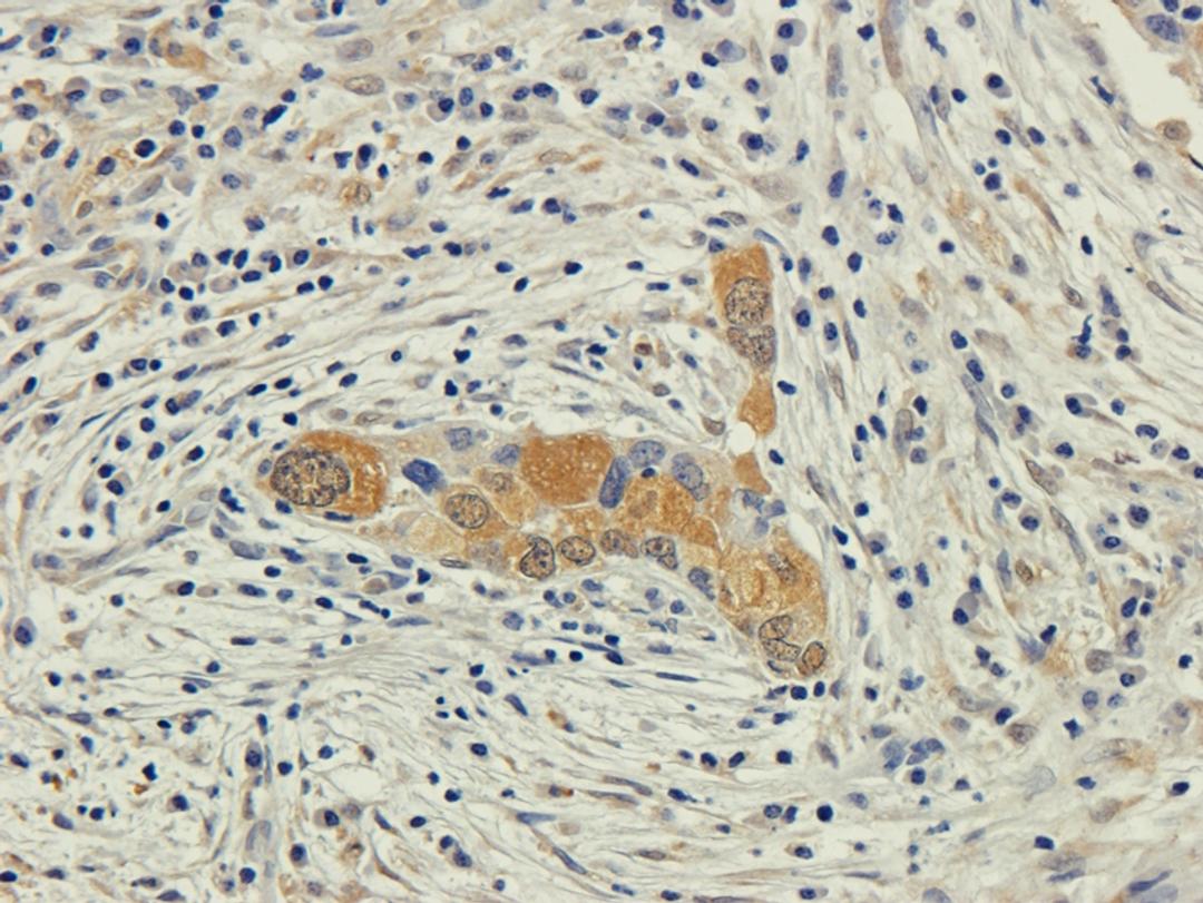 IHC-P staining of human lung cancer tissue using anti-EPOR (2.5 ug/ml)