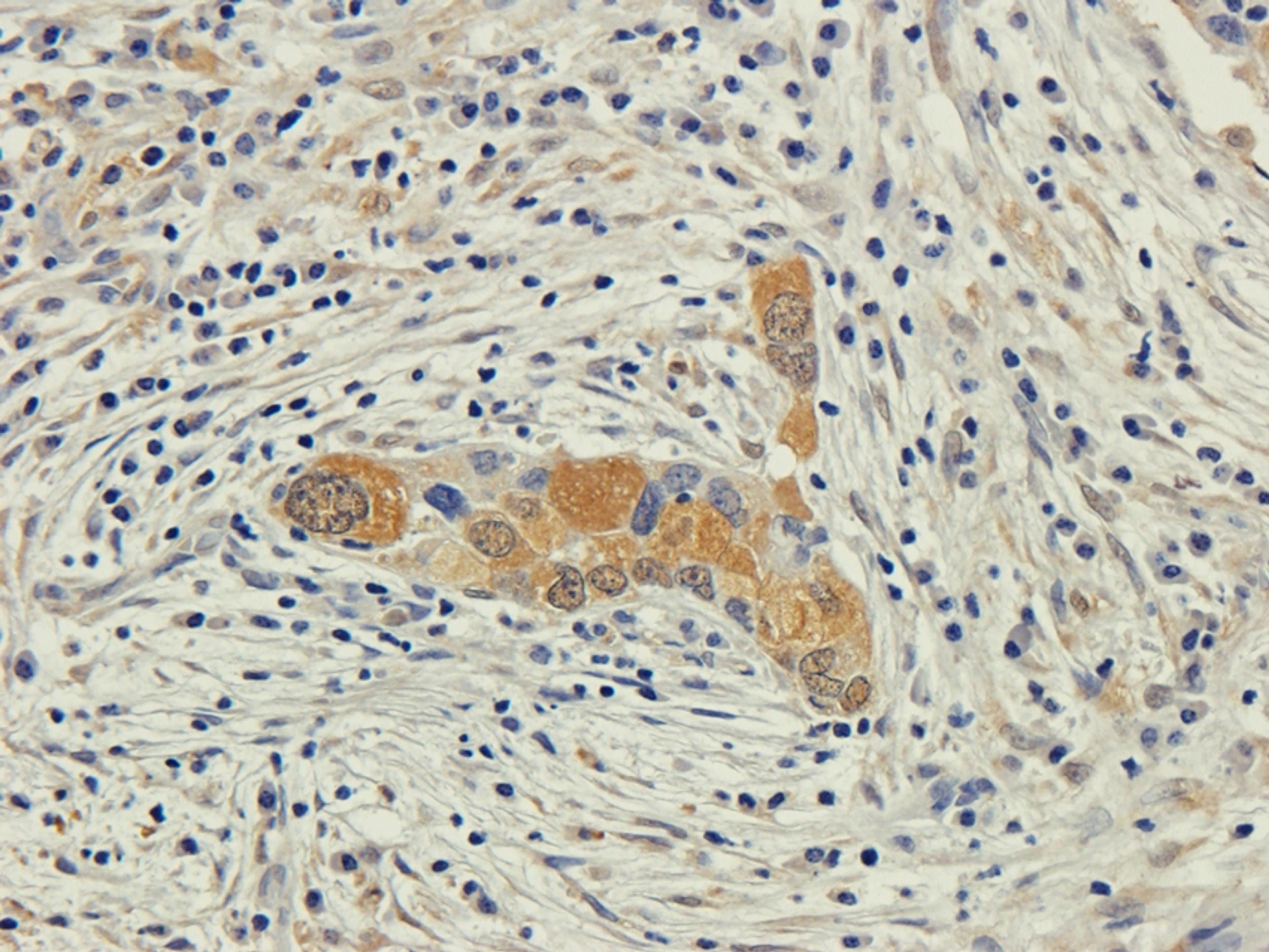 IHC-P staining of human lung cancer tissue using anti-EPOR (2.5 ug/ml)