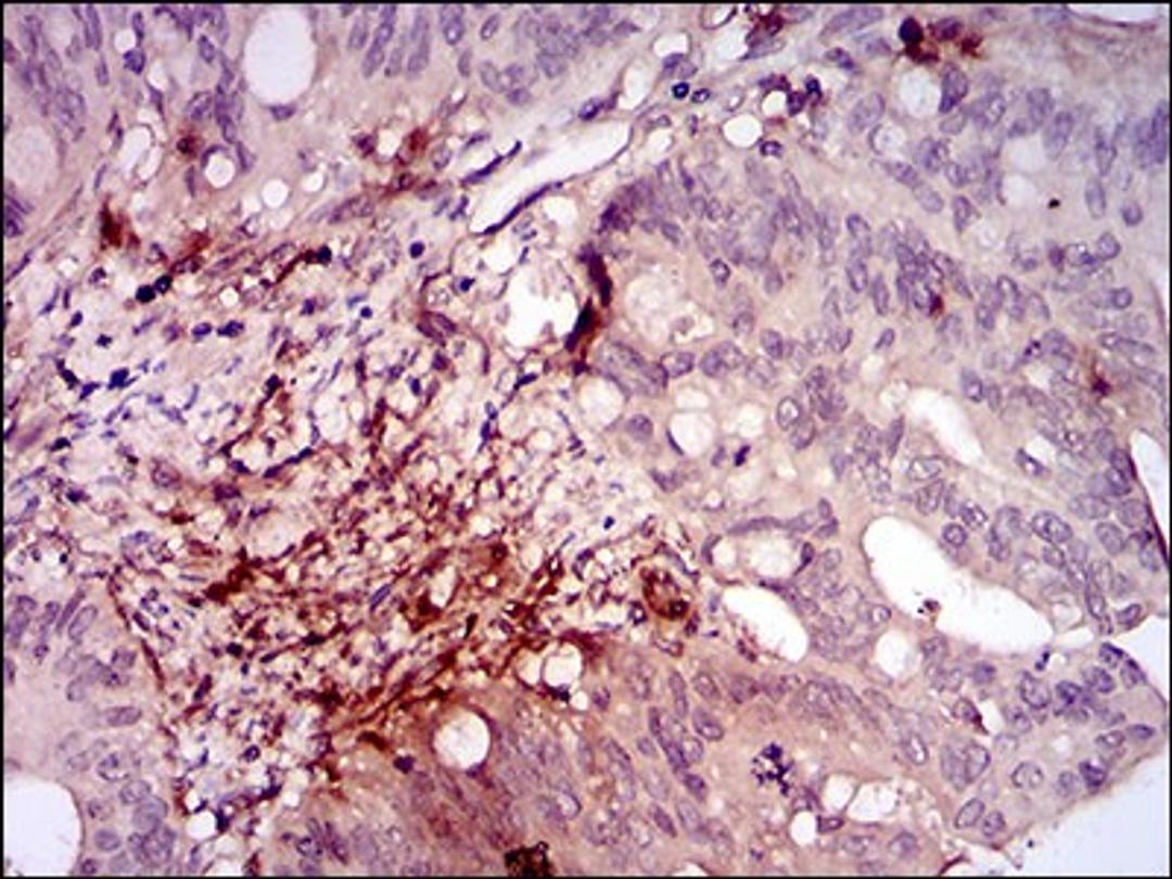 Immunohistochemistry: ILK Antibody (3A9) [NBP2-37448] - Immunohistochemical analysis of paraffin-embedded rectum cancer tissues using ILK mouse mAb with DAB staining.