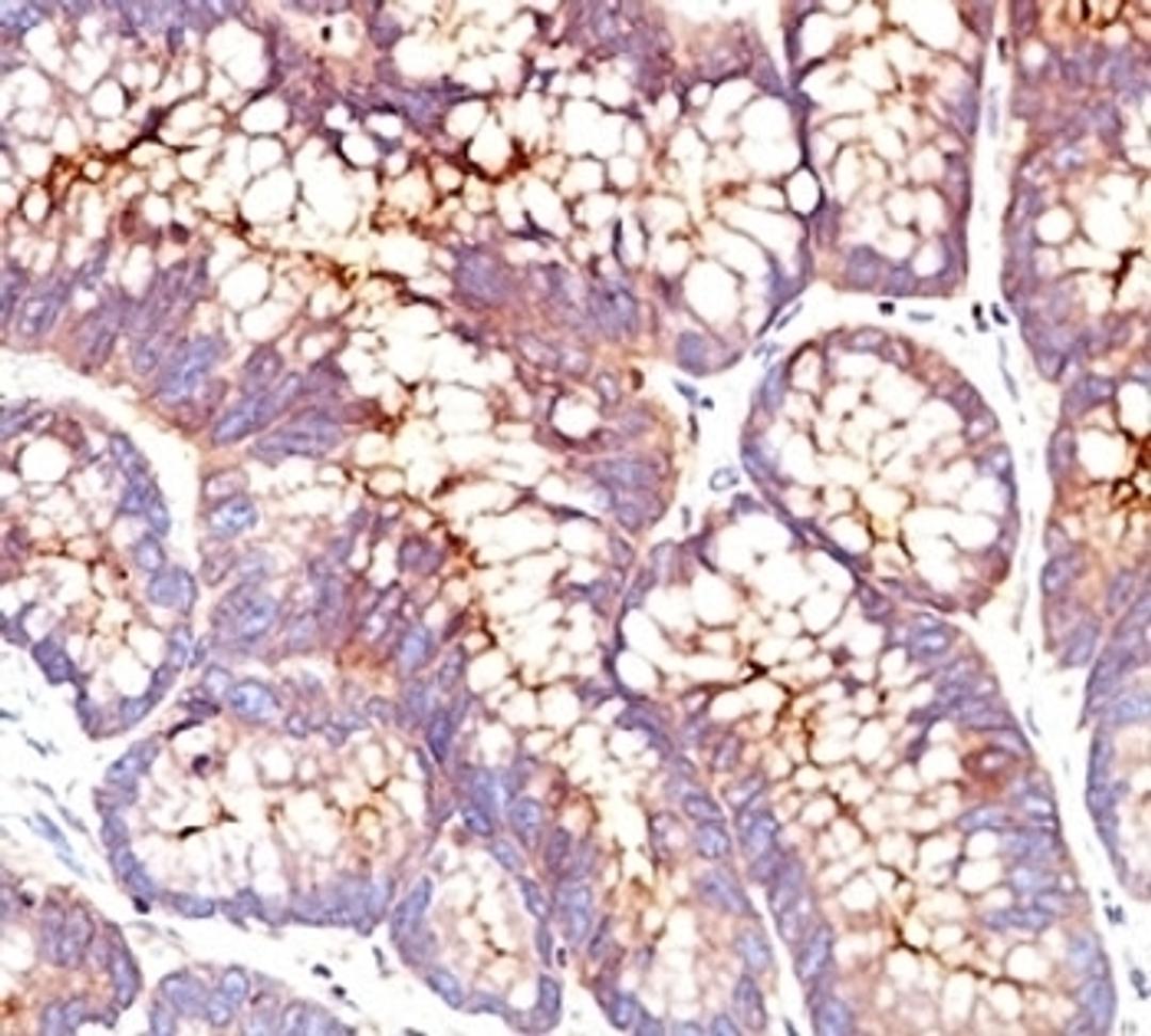 Formalin-fixed, paraffin-embedded human colon carcinoma stained with CEA antibody (SPM541)