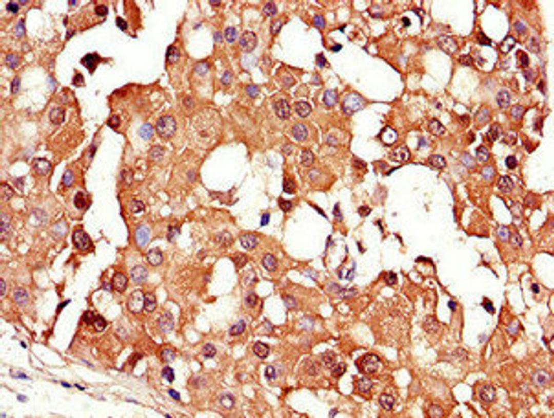 Immunohistochemistry of paraffin-embedded human breast cancer using CSB-PA005936LA01HU at dilution of 1:100