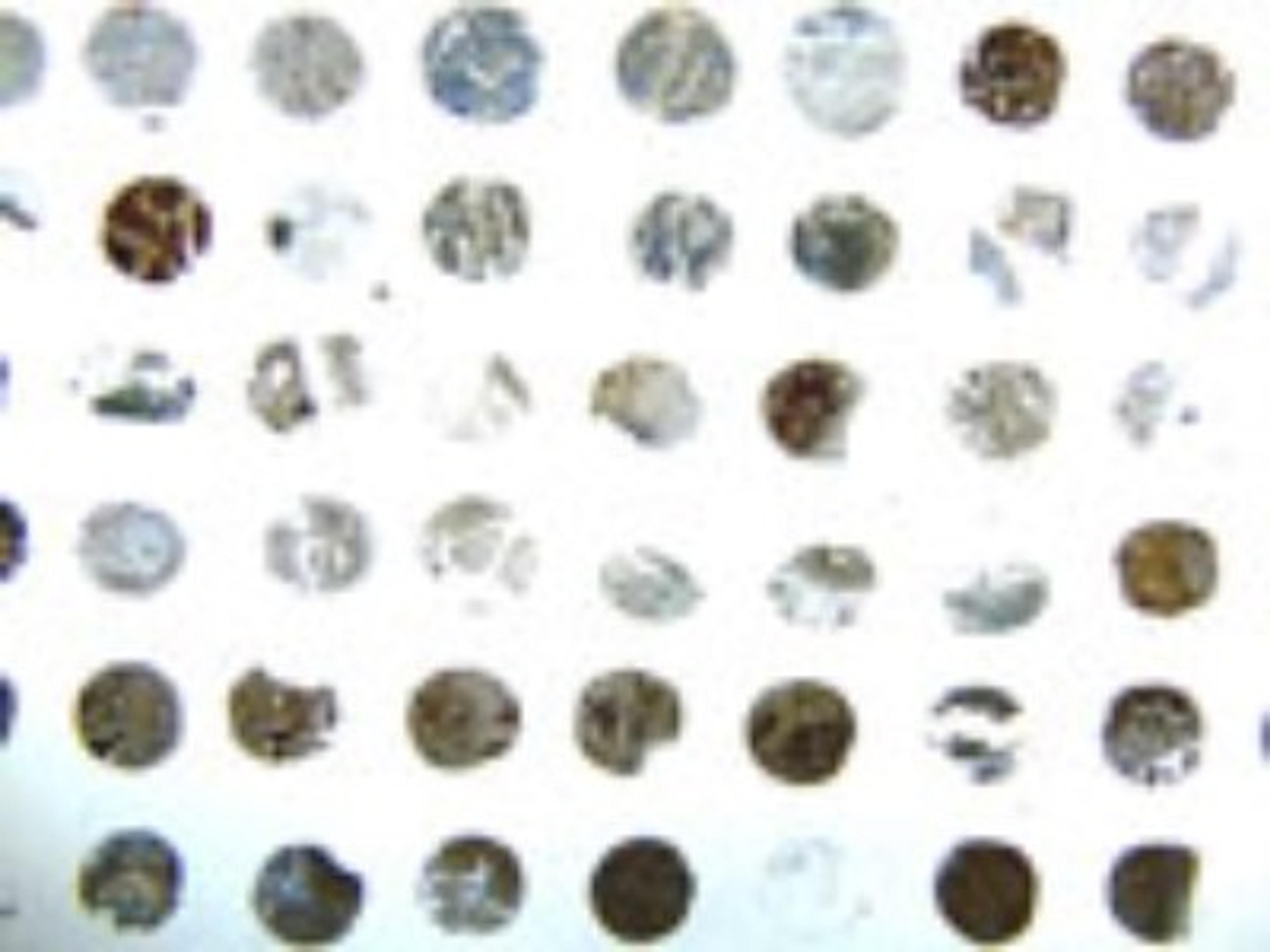 Immunohistochemistry-Paraffin: Bid Antibody [NB100-56106] - Formalin-fixed, paraffin-embedded human ovarian carcinoma tissue array stained for Bid expression using this antibody at 1:2000. Hematoxylin-eosin counterstain. Variable Bid expression is seen between patient samples.