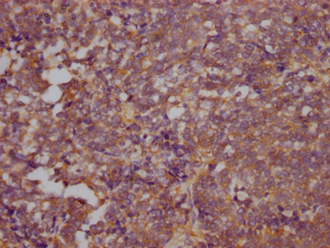 IHC image of CSB-RA546523A0HU diluted at 1:100 and staining in paraffin-embedded human lung cancer performed on a Leica BondTM system. After dewaxing and hydration, antigen retrieval was mediated by high pressure in a citrate buffer (pH 6.0). Section was blocked with 10% normal goat serum 30min at RT. Then primary antibody (1% BSA) was incubated at 4℃ overnight. The primary is detected by a Goat anti-rabbit IgG polymer labeled by HRP and visualized using 0.05% DAB.