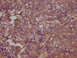 IHC image of CSB-RA546523A0HU diluted at 1:100 and staining in paraffin-embedded human lung cancer performed on a Leica BondTM system. After dewaxing and hydration, antigen retrieval was mediated by high pressure in a citrate buffer (pH 6.0). Section was blocked with 10% normal goat serum 30min at RT. Then primary antibody (1% BSA) was incubated at 4℃ overnight. The primary is detected by a Goat anti-rabbit IgG polymer labeled by HRP and visualized using 0.05% DAB.
