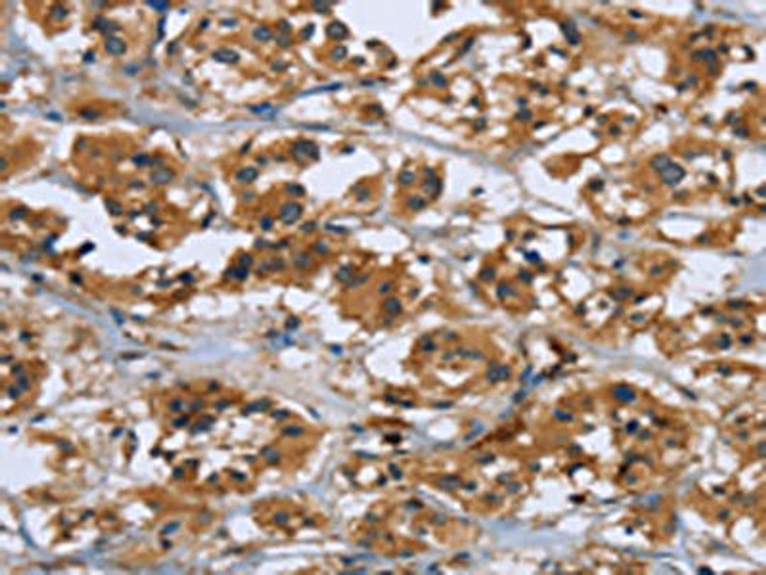 The image on the left is immunohistochemistry of paraffin-embedded Human thyroid cancer tissue using CSB-PA841145(RAP1B Antibody) at dilution 1/50, on the right is treated with fusion protein. (Original magnification: ×200)