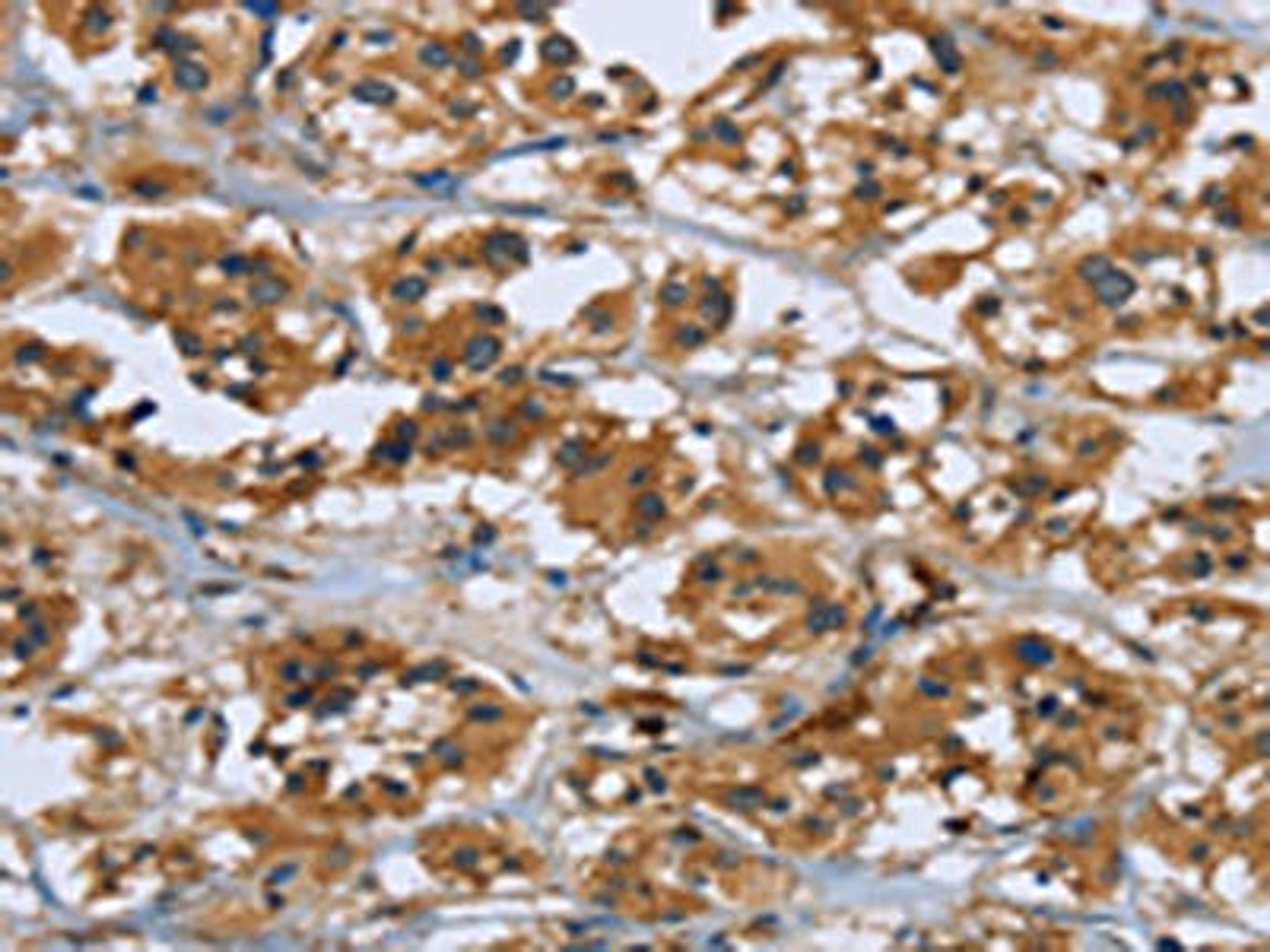 The image on the left is immunohistochemistry of paraffin-embedded Human thyroid cancer tissue using CSB-PA841145(RAP1B Antibody) at dilution 1/50, on the right is treated with fusion protein. (Original magnification: ×200)