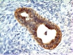 Formalin-fixed, paraffin-embedded human colon carcinoma stained with E-Cadherin antibody (CDH1/1121).