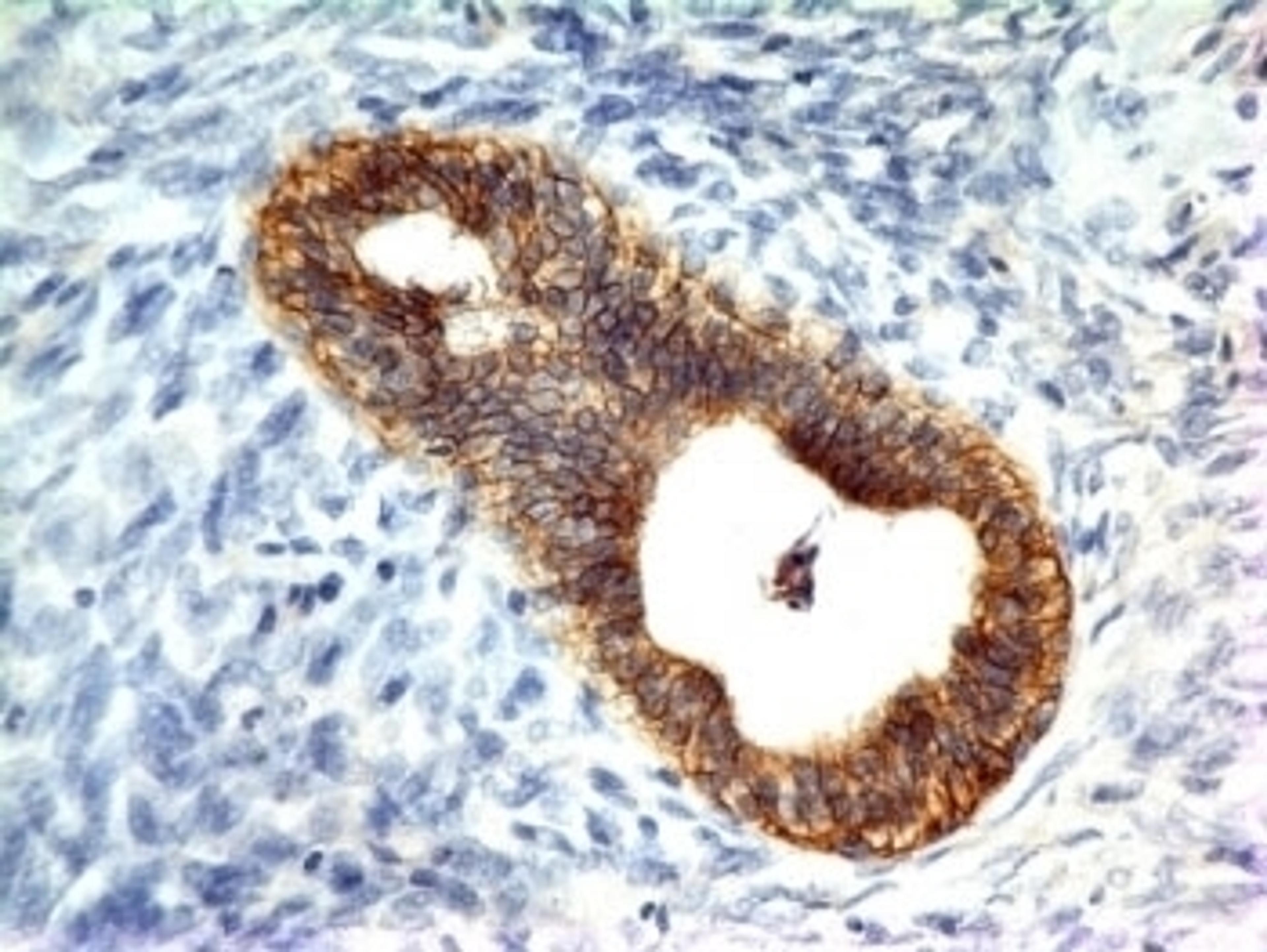 Formalin-fixed, paraffin-embedded human colon carcinoma stained with E-Cadherin antibody (CDH1/1121).