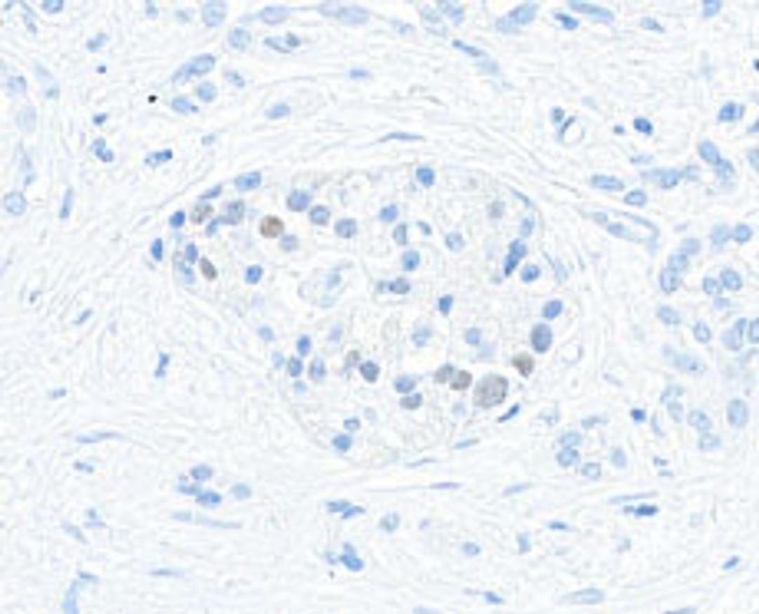 Detection of human MafA in FFPE pancreatic tumor by immunohistochemistry.