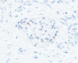 Detection of human MafA in FFPE pancreatic tumor by immunohistochemistry.