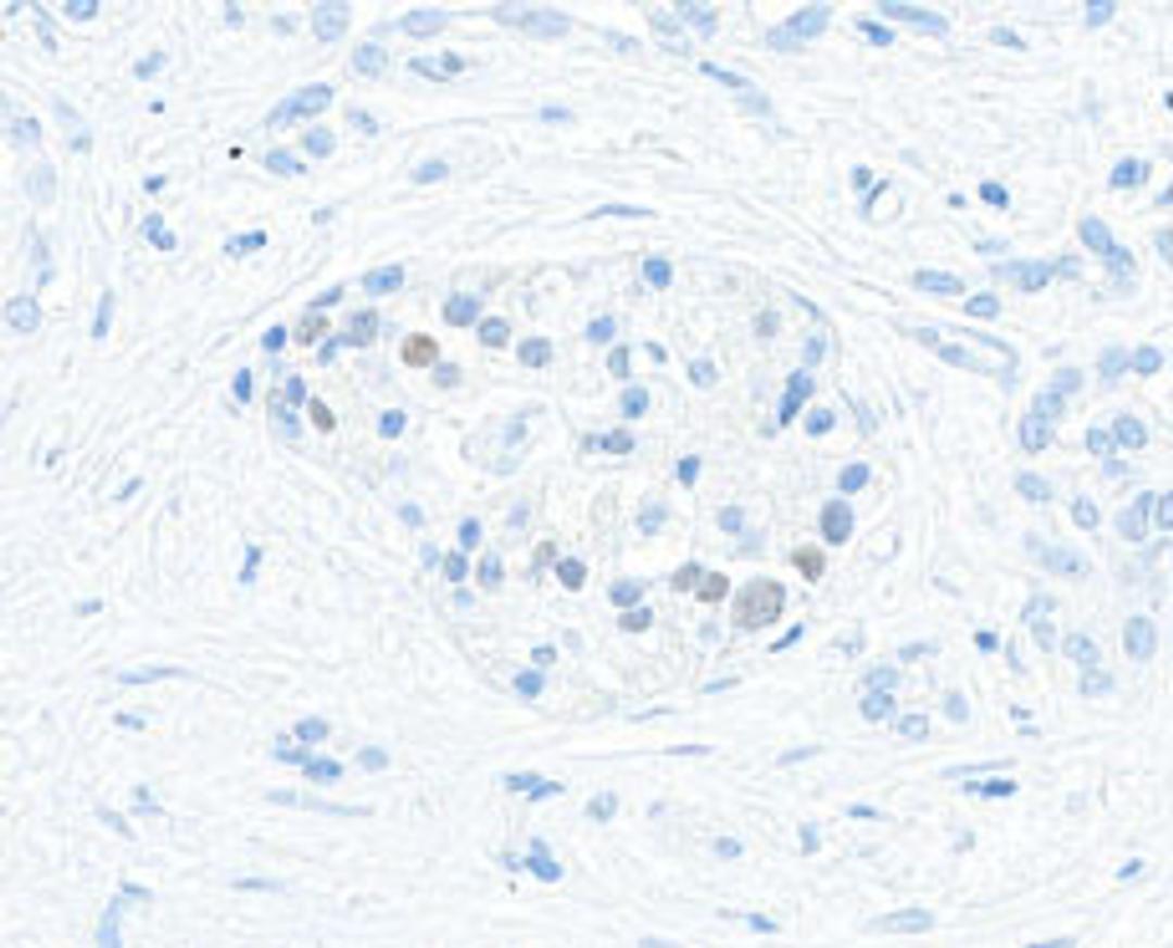 Detection of human MafA in FFPE pancreatic tumor by immunohistochemistry.