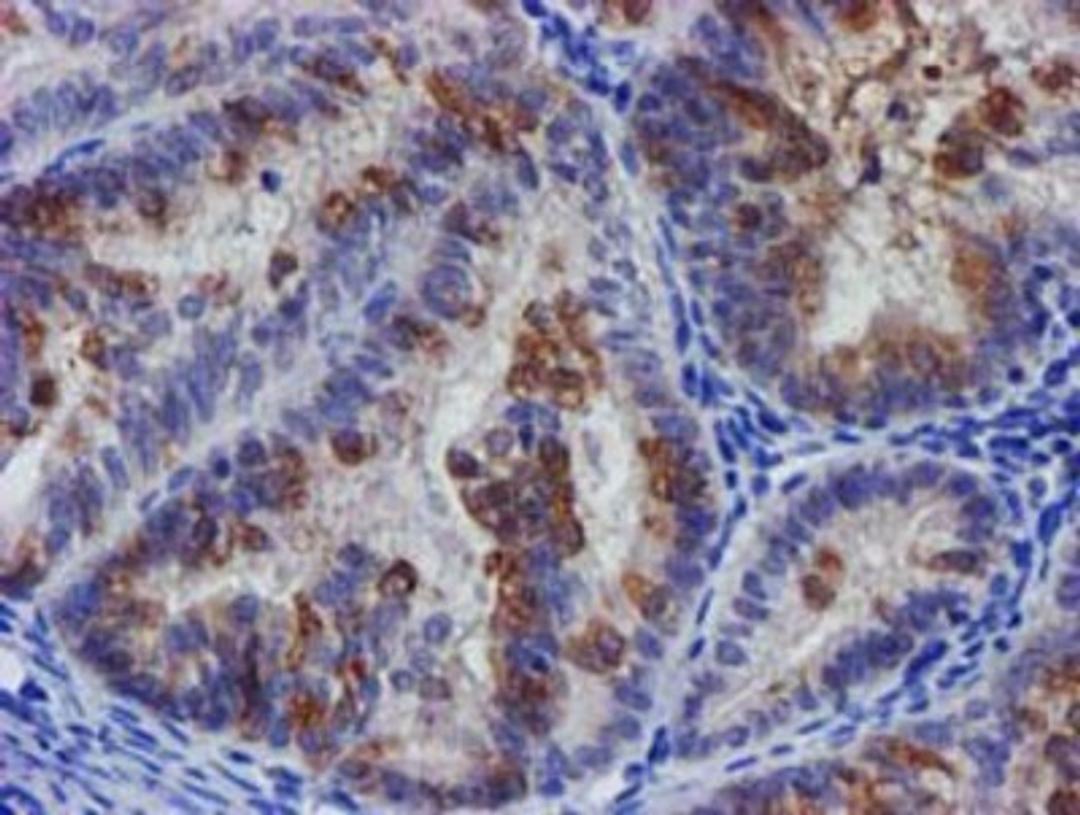 Immunohistochemistry-Paraffin: SLFNL1 Antibody (1G2) [NBP2-03192] - Staining of paraffin-embedded Adenocarcinoma of Human endometrium tissue using anti-SLFNL1 mouse monoclonal antibody.