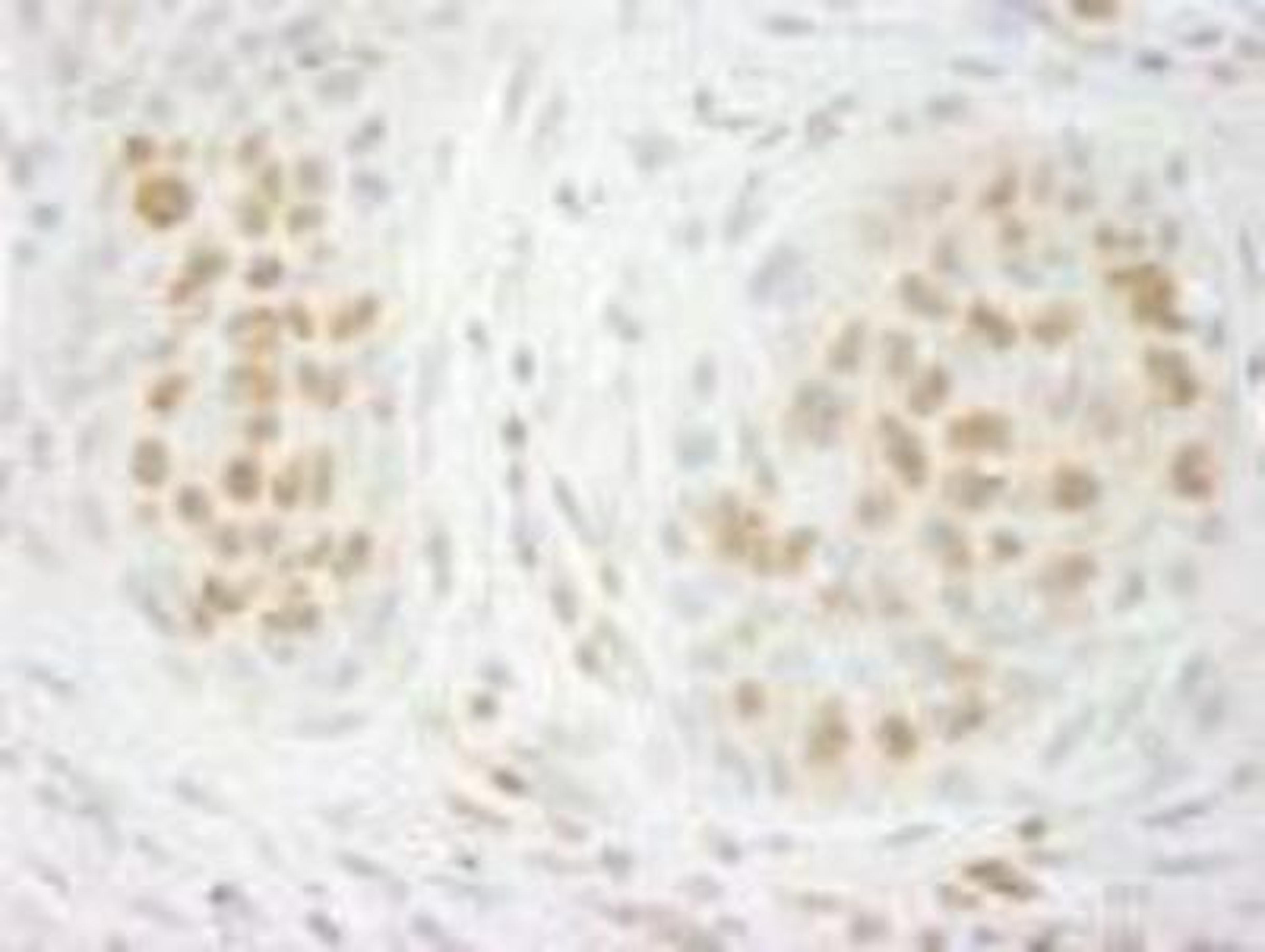 Immunohistochemistry-Paraffin: GIT2 Antibody [NBP1-19143] - FFPE section of human lung carcinoma.  Affinity purified rabbit anti-GIT2 used at a dilution of 1:500.