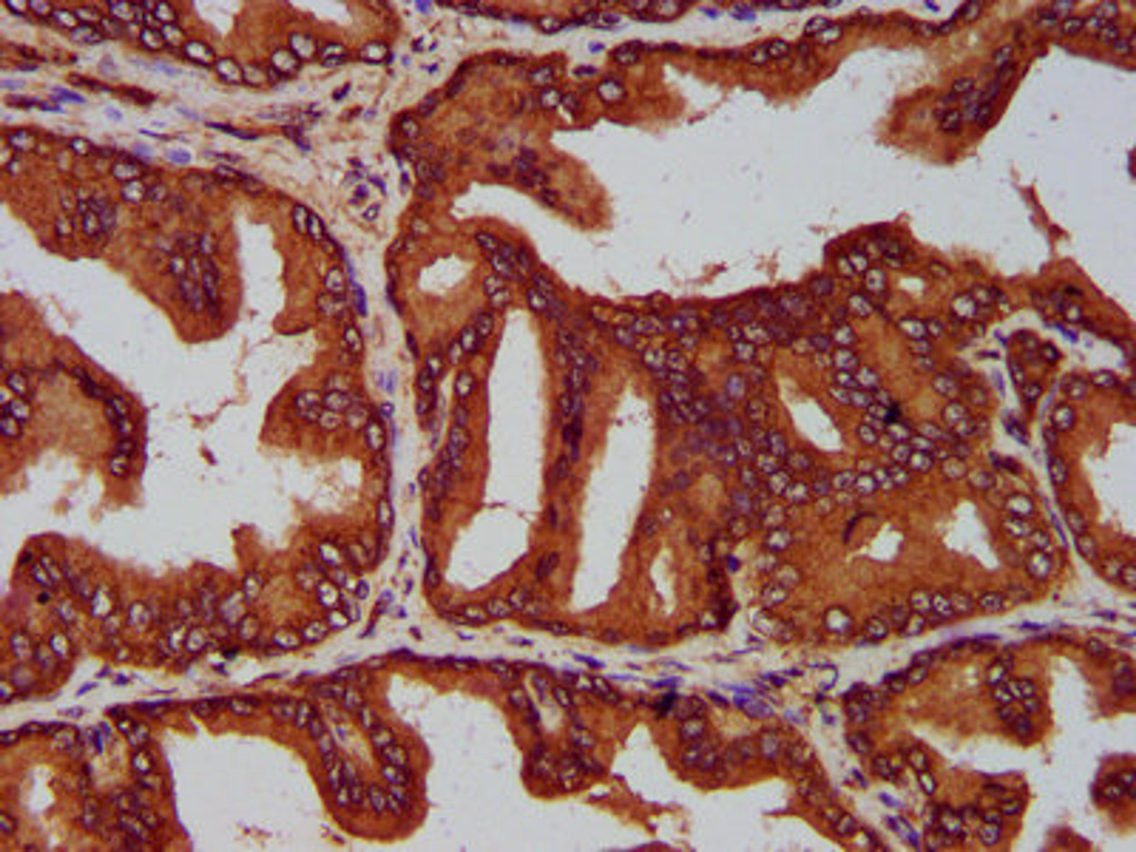 IHC image of CSB-PA769777LA01HU diluted at 1:200 and staining in paraffin-embedded human prostate tissue performed on a Leica BondTM system. After dewaxing and hydration, antigen retrieval was mediated by high pressure in a citrate buffer (pH 6.0). Section was blocked with 10% normal goat serum 30min at RT. Then primary antibody (1% BSA) was incubated at 4°C overnight. The primary is detected by a biotinylated secondary antibody and visualized using an HRP conjugated SP system.