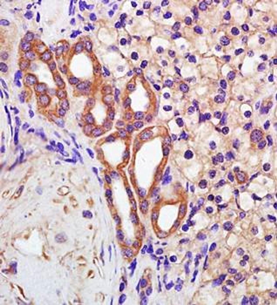 Paraffin-embedded human kidney carcinoma fixed with 4% paraformaldehyde. Antigen retrieval by boiling with citrate buffer. Blocking buffer is goat serum (37 degrees for 20 min.). Polycystin 2 antibody at 1:200 dilution with overnight incubation at 4 degre