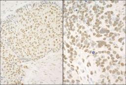 Immunohistochemistry-Paraffin: GMEB1 Antibody [NBP1-46207] - Human lung carcinoma (left) and mouse teratoma (right).  Antibody used at a dilution of 1:1,000.