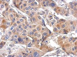 Immunohistochemistry-Paraffin: ILT7/CD85g/LILRA4 Antibody [NBP2-15012] - Paraffin-embedded Breast ca, using antibody at 1:500 dilution.