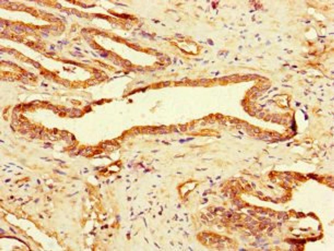 Immunohistochemical staining of human prostate cancer using GAA antibody