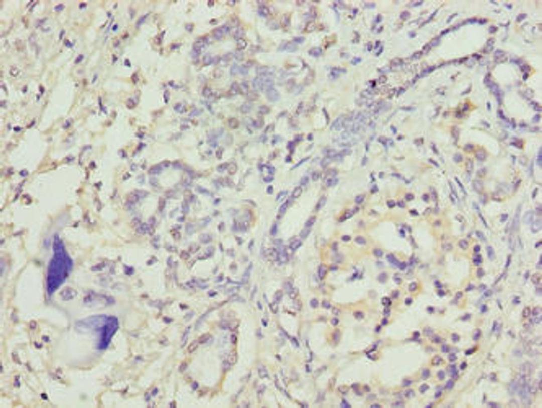 Immunohistochemistry of paraffin-embedded human pancreatic cancer using CSB-PA624011LA01HU at dilution of 1:100