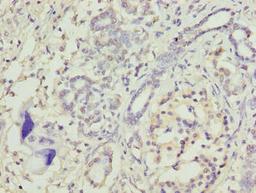 Immunohistochemistry of paraffin-embedded human pancreatic cancer using CSB-PA624011LA01HU at dilution of 1:100