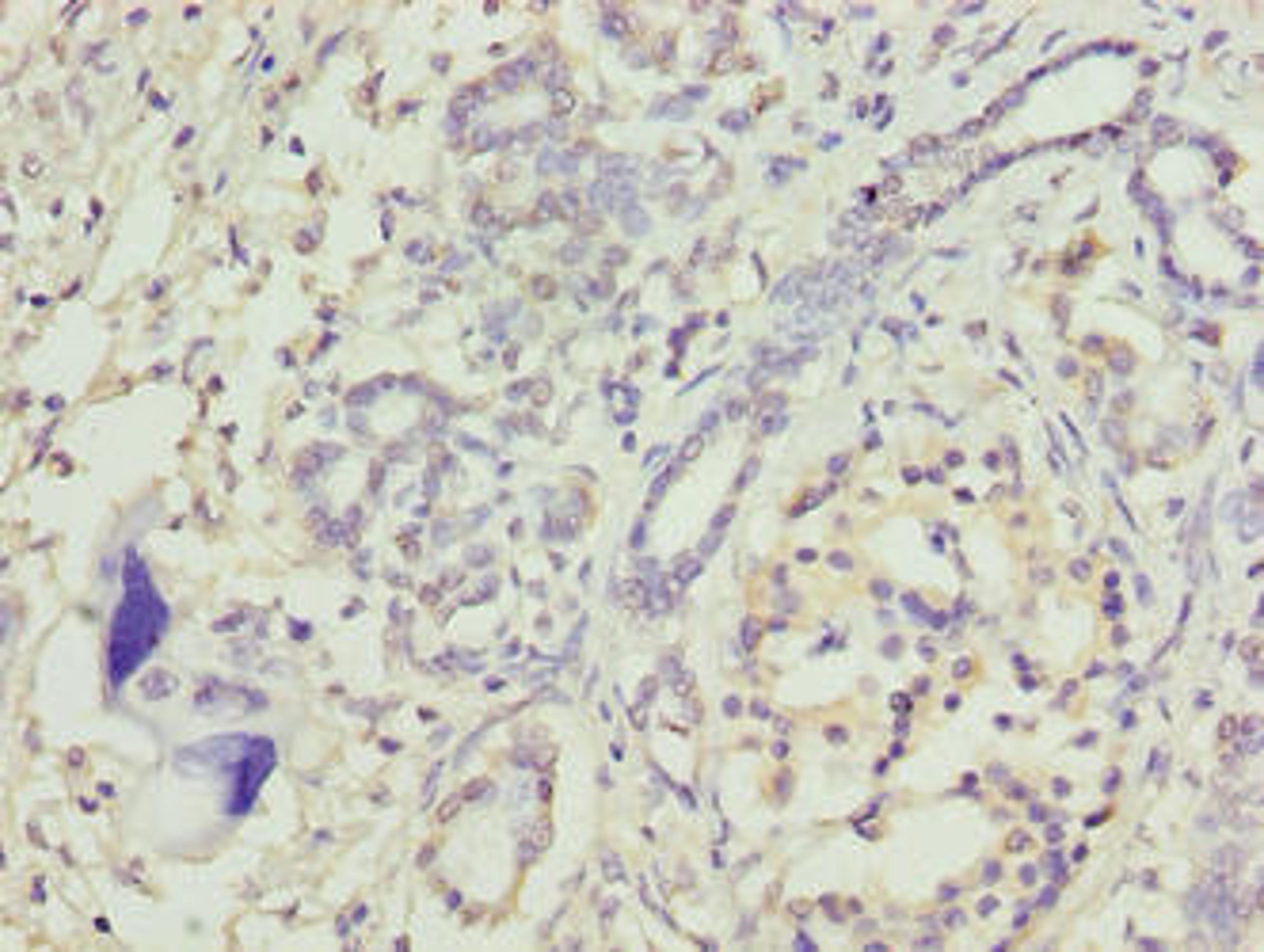 Immunohistochemistry of paraffin-embedded human pancreatic cancer using CSB-PA624011LA01HU at dilution of 1:100