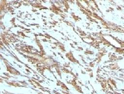 IHC testing of FFPE human leiomyosarcoma with Muscle Actin antibody