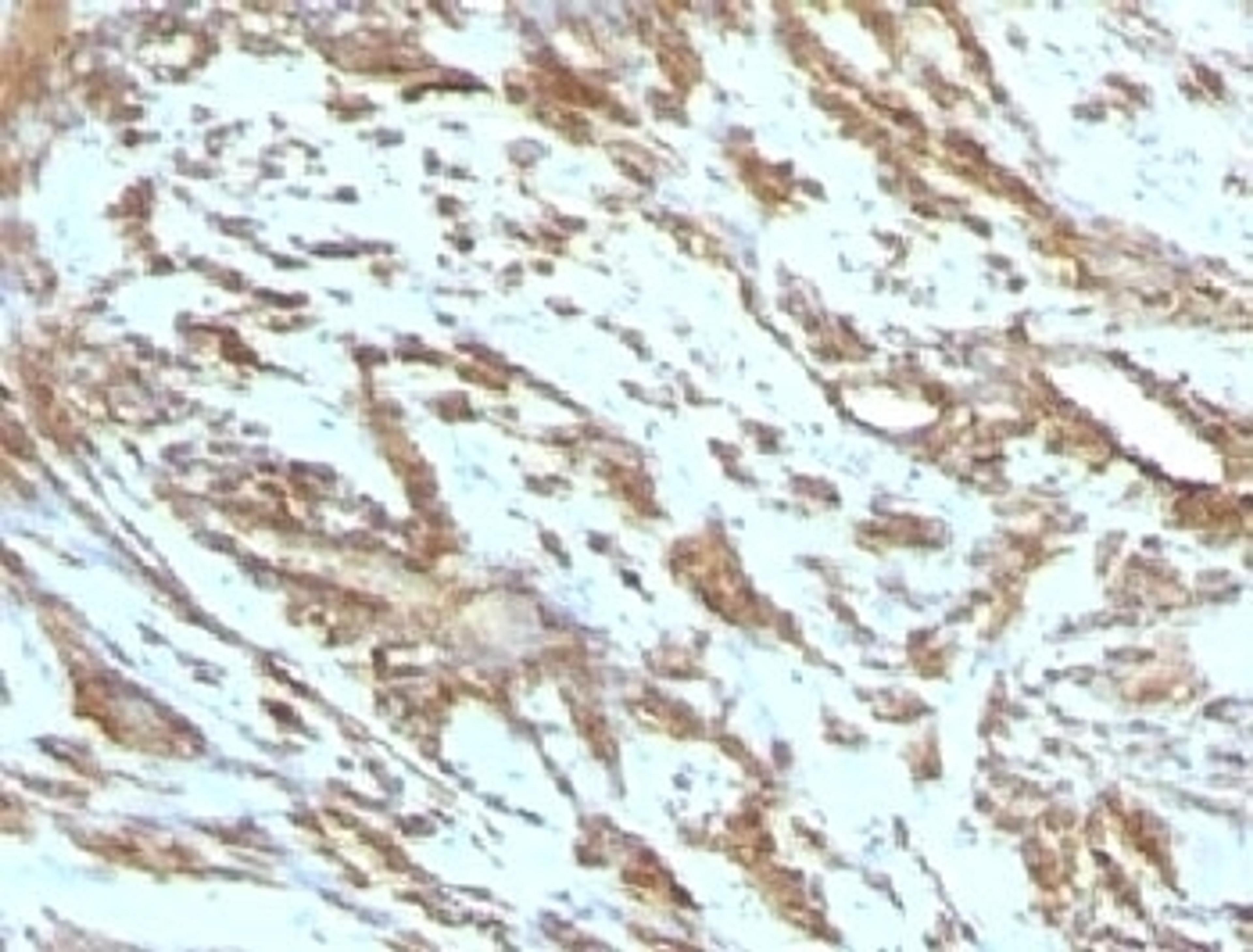 IHC testing of FFPE human leiomyosarcoma with Muscle Actin antibody