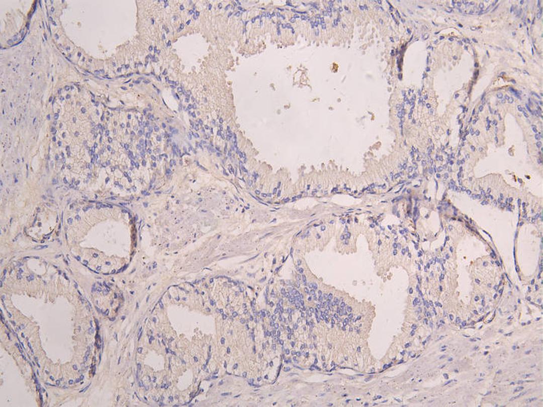 IHC image of CSB-RA878931MA1HU diluted at 1:100 and staining in paraffin-embedded human prostate cancer performed on a Leica BondTM system. After dewaxing and hydration, antigen retrieval was mediated by high pressure in a citrate buffer (pH 6.0). Section was blocked with 10% normal goat serum 30min at RT. Then primary antibody (1% BSA) was incubated at 4°C overnight. The primary is detected by a Goat anti-human polymer IgG labeled by HRP and visualized using 0.05% DAB.