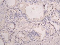 IHC image of CSB-RA878931MA1HU diluted at 1:100 and staining in paraffin-embedded human prostate cancer performed on a Leica BondTM system. After dewaxing and hydration, antigen retrieval was mediated by high pressure in a citrate buffer (pH 6.0). Section was blocked with 10% normal goat serum 30min at RT. Then primary antibody (1% BSA) was incubated at 4°C overnight. The primary is detected by a Goat anti-human polymer IgG labeled by HRP and visualized using 0.05% DAB.