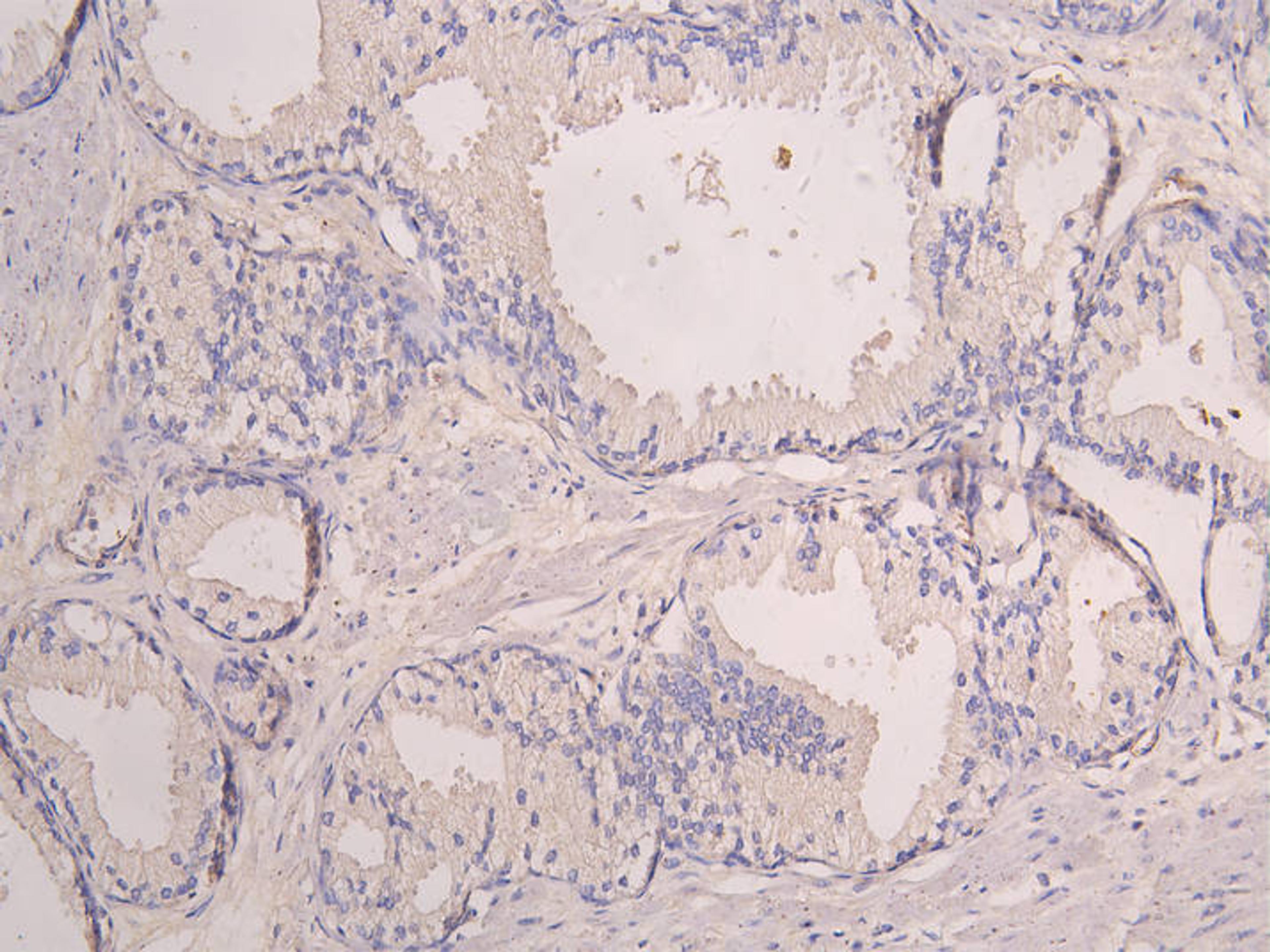IHC image of CSB-RA878931MA1HU diluted at 1:100 and staining in paraffin-embedded human prostate cancer performed on a Leica BondTM system. After dewaxing and hydration, antigen retrieval was mediated by high pressure in a citrate buffer (pH 6.0). Section was blocked with 10% normal goat serum 30min at RT. Then primary antibody (1% BSA) was incubated at 4°C overnight. The primary is detected by a Goat anti-human polymer IgG labeled by HRP and visualized using 0.05% DAB.