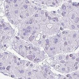 Immunohistochemistry: OR1B1 Antibody [NBP2-32396] - liver cancer