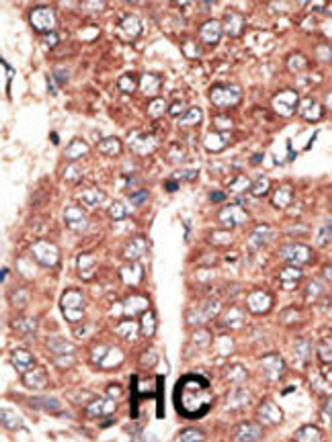 Formalin-fixed and paraffin-embedded human cancer tissue reacted with the primary antibody, which was peroxidase-conjugated to the secondary antibody, followed by AEC staining. BC = breast carcinoma; HC = hepatocarcinoma.