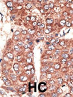 Formalin-fixed and paraffin-embedded human cancer tissue reacted with the primary antibody, which was peroxidase-conjugated to the secondary antibody, followed by AEC staining. BC = breast carcinoma; HC = hepatocarcinoma.