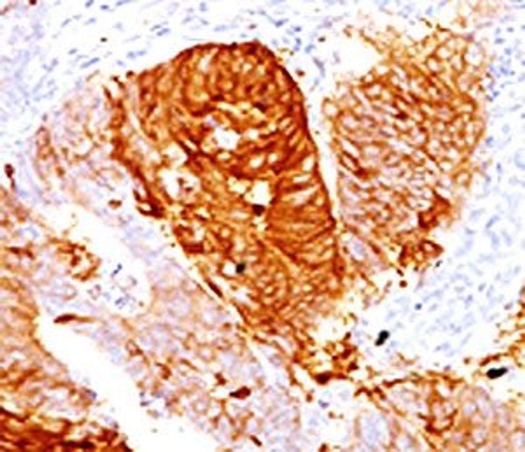 Immunohistochemical staining of FFPE human colon carcinoma using ALDH1 antibody