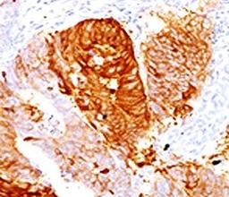 Immunohistochemical staining of FFPE human colon carcinoma using ALDH1 antibody