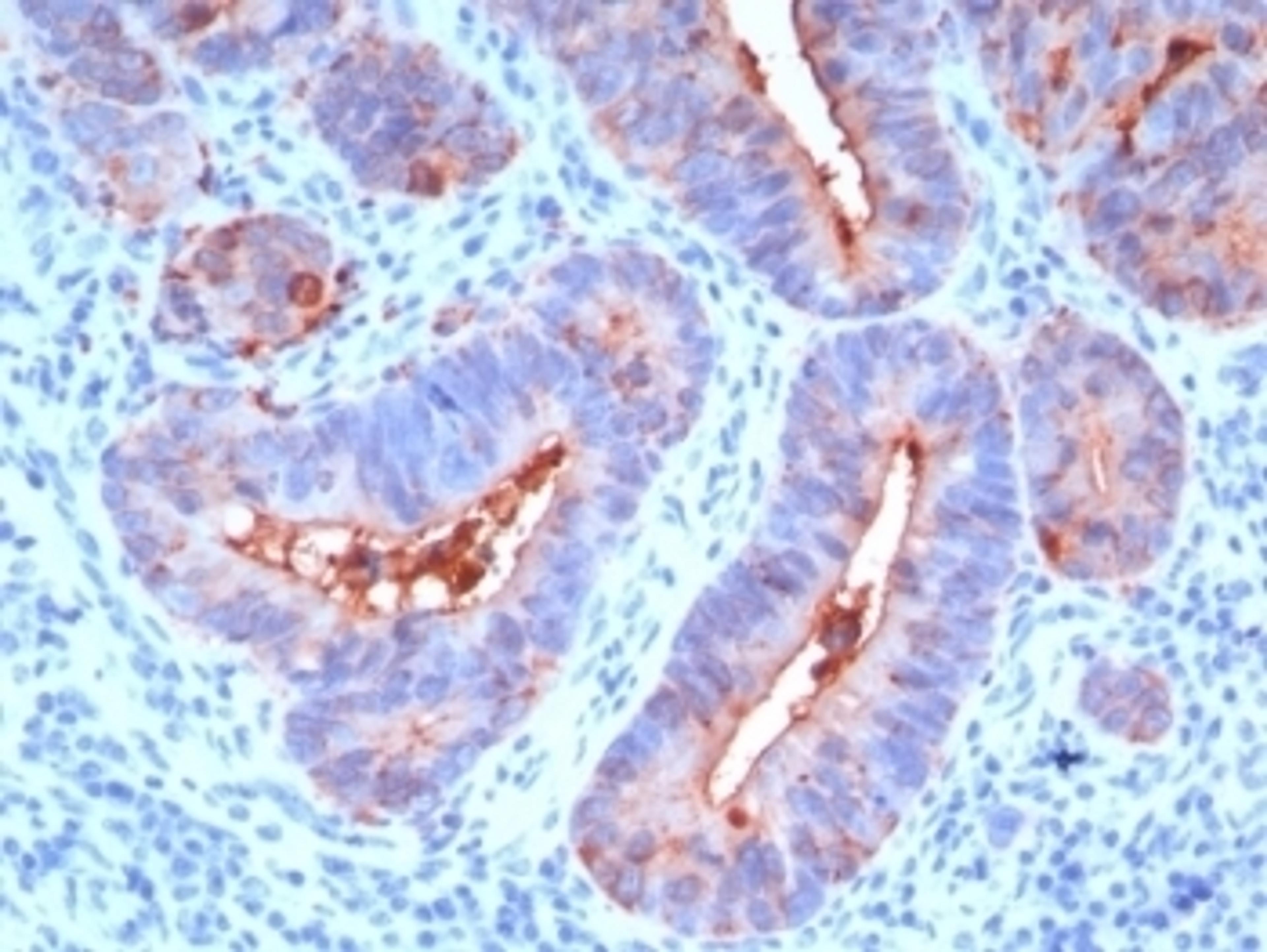 Formalin-fixed, paraffin-embedded human colon carcinoma stained with CEA antibody (C66/195).