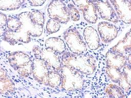 Immunohistochemistry-Paraffin: TSG101 Antibody (4A10) [NB200-112] - Paraffin-embedded Colon carcinoma, using antibody at 1:100 dilution.