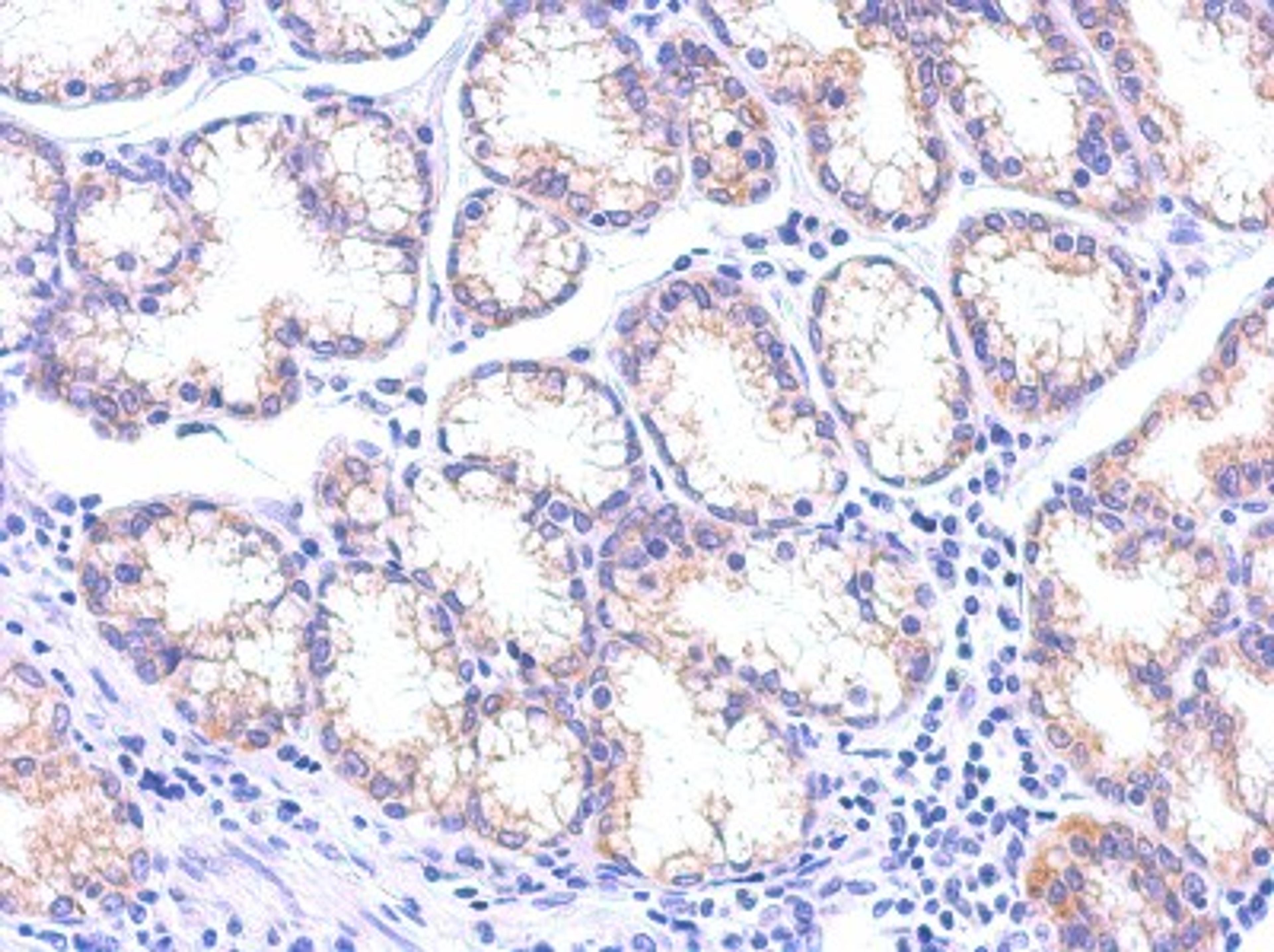 Immunohistochemistry-Paraffin: TSG101 Antibody (4A10) [NB200-112] - Paraffin-embedded Colon carcinoma, using antibody at 1:100 dilution.