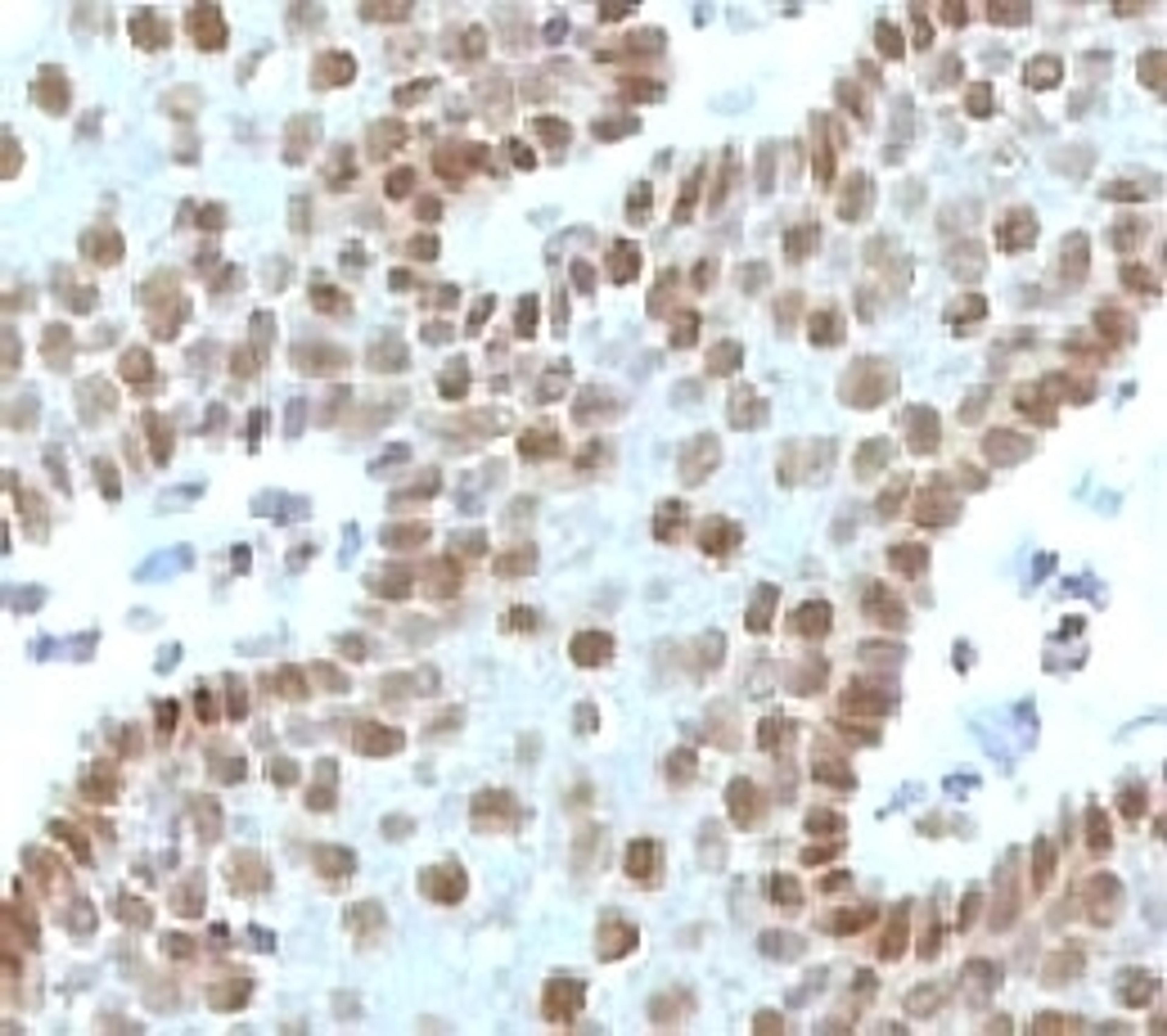 IHC testing of FFPE human cervical carcinoma and c-Myc antibody (MVH39-1).