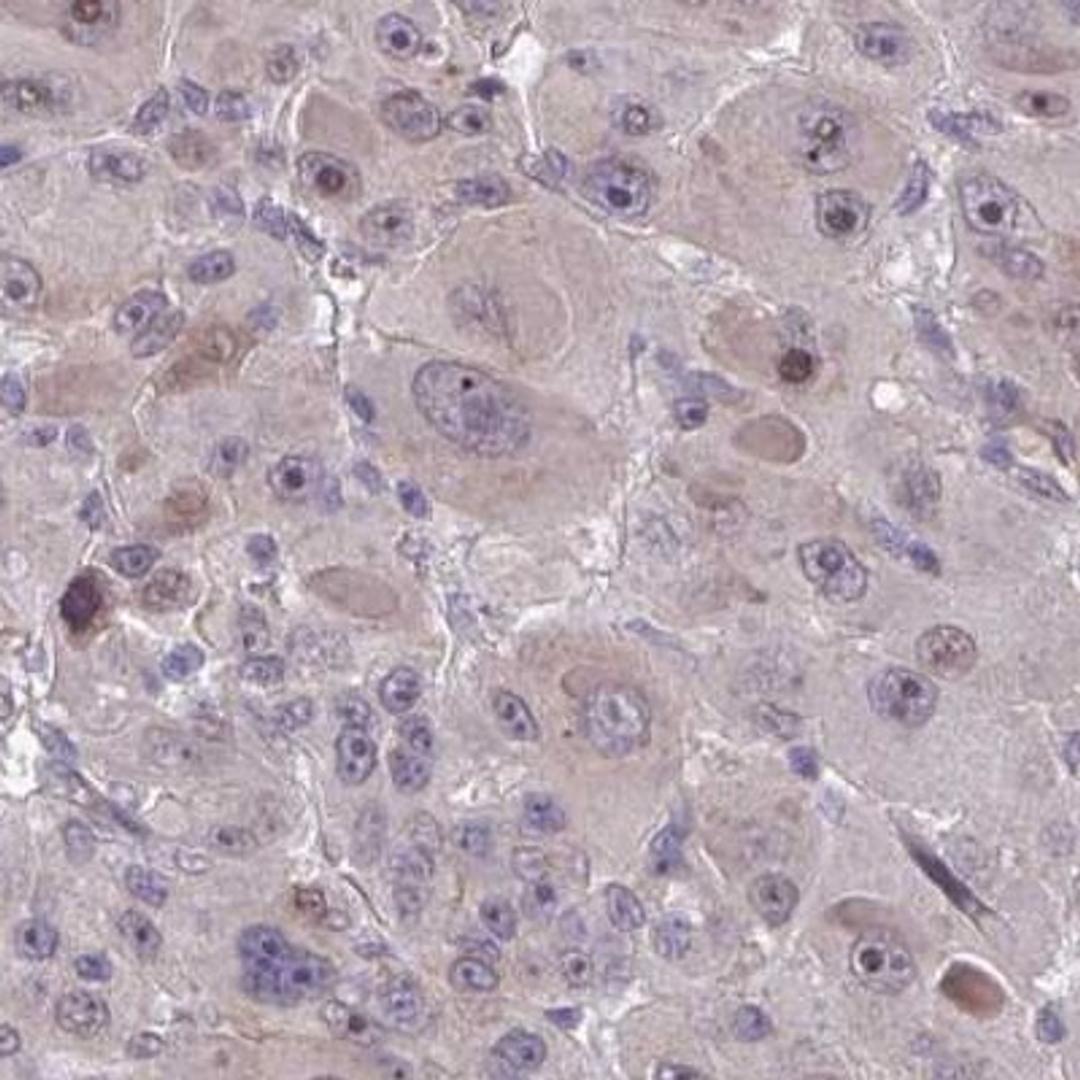 Immunohistochemistry: RBM18 Antibody [NBP2-31670] - liver cancer