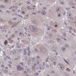 Immunohistochemistry: RBM18 Antibody [NBP2-31670] - liver cancer